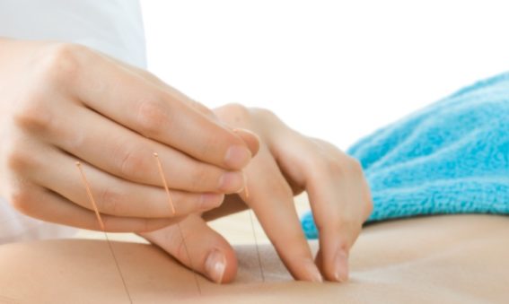 Close up of hands and acupuncture needles being inserted into skin on a back